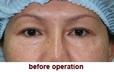 plastic-surgery-blepharoplasty